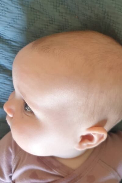 Why Do Babies Get Cradle Cap