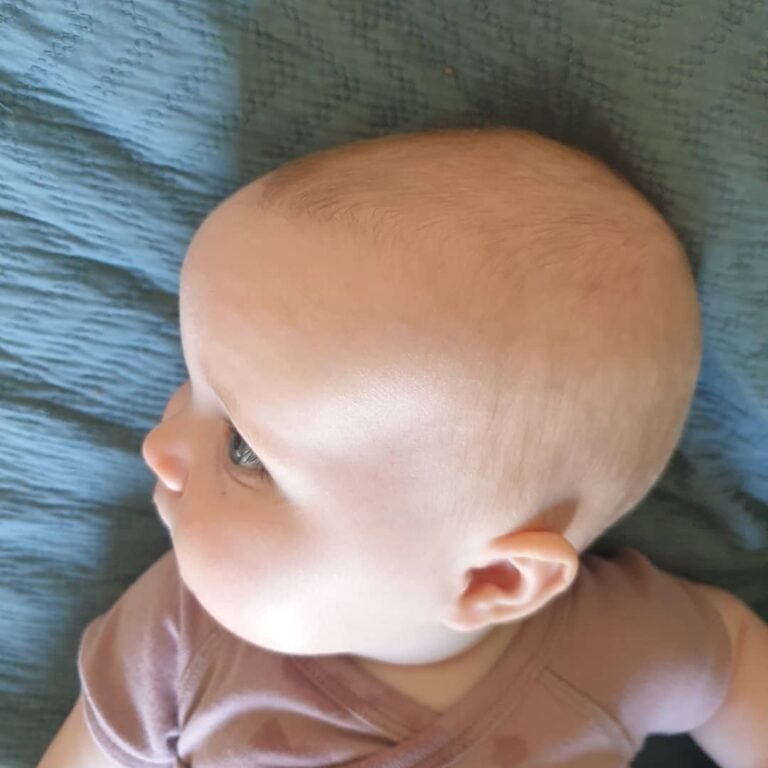 Why Do Babies Get Cradle Cap